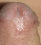 Imagen de hipospadias con placa uretral escasa