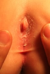 Sinequia labios menores en niña