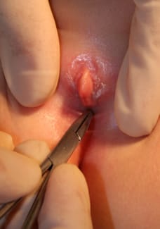 Imagen de la separación de las sinequias labios menores en niña