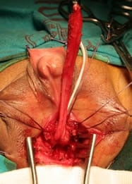 Vagina extradia via perineal