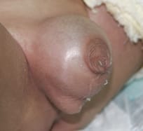 Embolsamiento de orina en prepucio en niño con fimosis