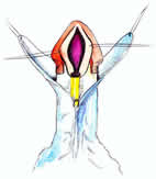 Esquema de la Técnica de Snodgrass
