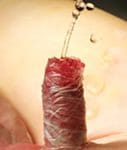 Imagen de pene con vendaje adhesivo trasparente tras cirugía moderna del hipospadias