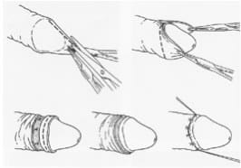 Esquema de la cirugía de la circuncisión
