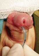 imagen pene con hipospadias con sonda