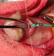 Imagen pene hipospadico demostrando doble uretra