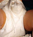 Tratamiento moderno del hipospadias imagen de doble pañal