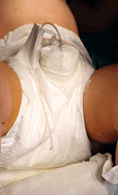 Tratamiento moderno del hipospadias imagen de doble pañal