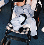 Tratamiento moderno del hipospadias imagen de doble pañal