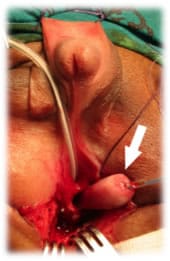 Imagen de la vagina extraída por la herida perineal