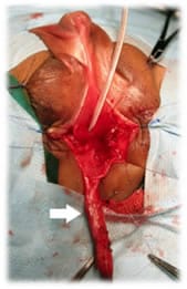 Vagina extradia via perineal