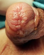 imagen de meatoestenosis tras cirugía de hipospadias