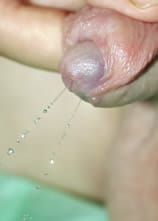 Imagen Fistula hipospadias puntiforme