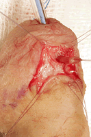 Disección quirúrgica fístula puntiforme