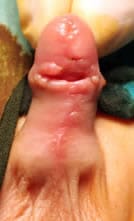 Fístula de hipospadias grande