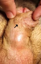 Fístula hipospadias puntiforme peneana