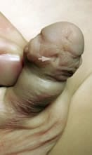 Fistula de hipospadias coronal