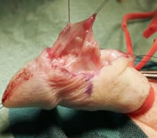 Disección de Colgajo Dartos para cubrir uretra