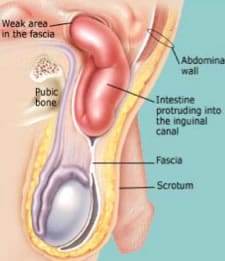 Esquema anatomía del canal inguinal con hernia