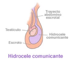 Esquema de la anatomia del canal inguinal en caso de hidrocele
