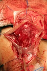 Técnica clásica de hipospadias de Koyanagi, flaps pediculados pasados a la cara ventral