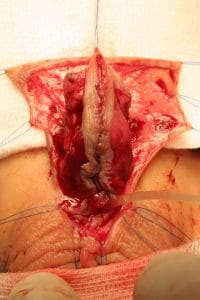 Técnica clásica de hipospadias de Koyanagi flaps pediculados suturados en cara ventral