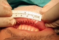 Imagen de labio después de tomar injerto mucoso