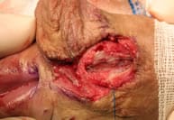 Imagen de mucosa bucal colocada inlay para corregir estenosis de uretra