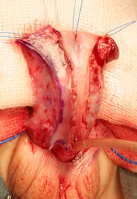 Técnica clásica de hipospadias de Onlay, flap suturado a placa uretral