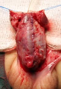 Tecnica clásicas de hipospadias de Onlay imagen de la neouretra completada