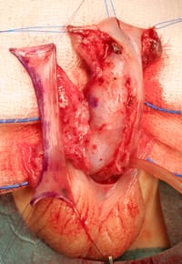 Técnica clásica de hipospadias de Onlay flap rectangular pediculado de mucosa prepucio