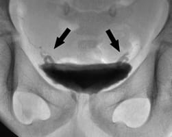 Imagen de reflujo conducto deferente como consecuencia de estenosis