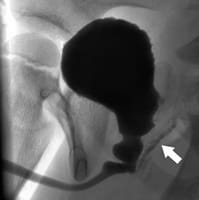 Imagen de reflujo conducto deferente como consecuencia de estenosis