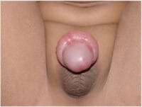 Imagen de niño con para fimosis