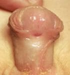 Imagen de hipospadias con placa plana