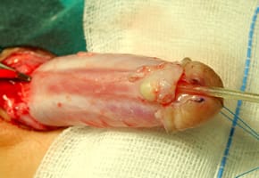 Quiste de inclusión en niño intervenido de hipospadias