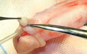 Quiste de inclusión en niño intervenido de hipospadias