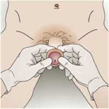 Dibujo de maniobra para reducir una parafimosis