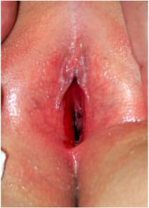 Sinequias labios menores