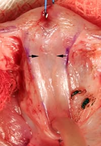 Imagen de incisión de la placa en el tratamiento moderno del hipospadias