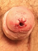 Imagen de una Meatotomía para tratar una estenosis de meato