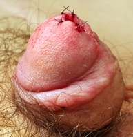 Imagen de una Meatotomía para tratar una estenosis de meato