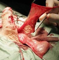 Imagen del momento de la extracción de un colgajo de vaginal testicular
